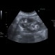 Angiomyolipoma: US - Ultrasound